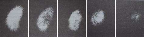 Classification Of Renal Scarring According To Findings At 99mtcdmsa