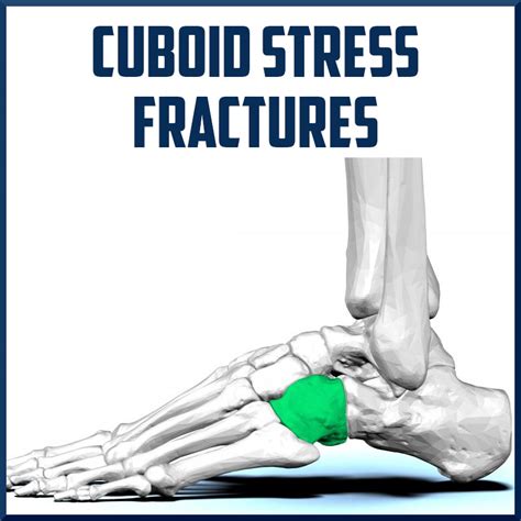Cuboid Stress Fractures Sports Activities Medication Evaluate Foppa