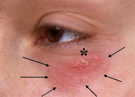 Red Dots Around Eyes 10 Causes And Treatments Yummylooks