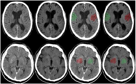 Frontiers Value Of Dual Energy Dual Layer CT After Mechanical