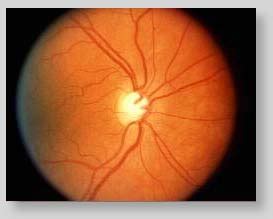 Fundus Photography Overview Ophthalmic Photographers Society
