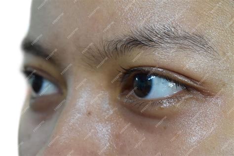 Premium Photo Dark Circles Around Eyes Of Asian Woman Brown
