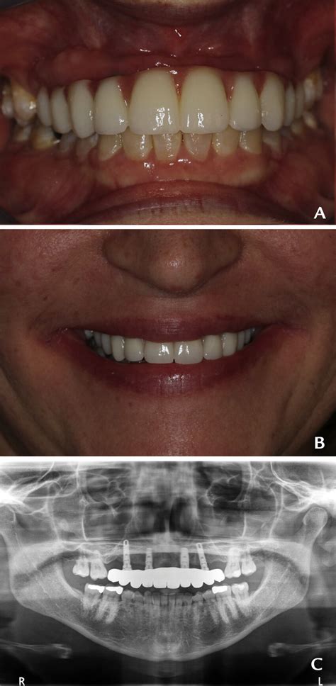 Definitive Prosthesis A Intraoral View B Extraoral Smile View C