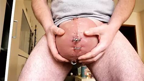 Saline Infusion In Scrotum Second Liter Nude Pics XHamster