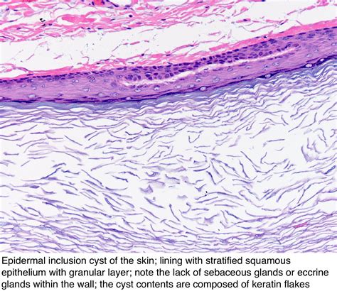 Epidermal Inclusion Cyst Histology