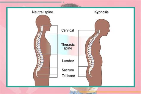 Hunch Back Definition Causes And Types Naturalbeauty
