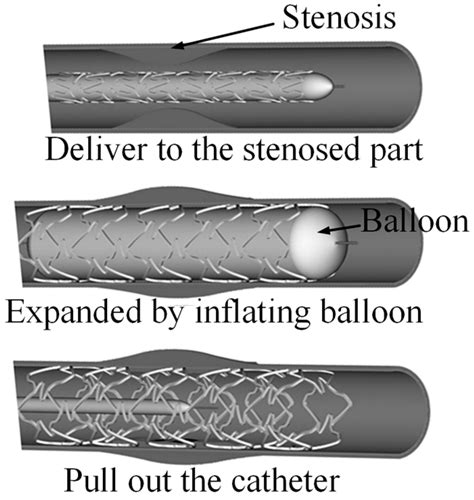 Expanding Balloon