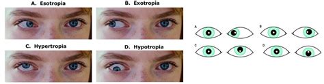 Squint Eye Treatment in Mumbai | Strabismus Surgery - Kenia Eye Hospital