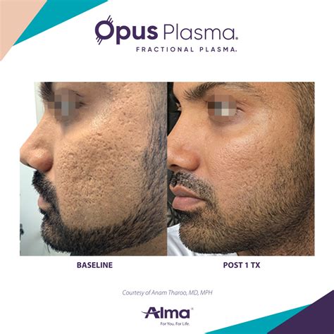 Opus Plasma Treatment Your Skincare Solution Colair Beauty Lounge