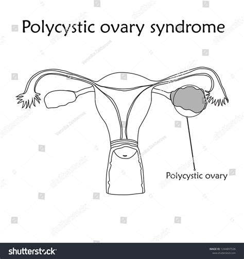 Polycystic Ovary Syndrome Human Realistic Uterus Vector De Stock