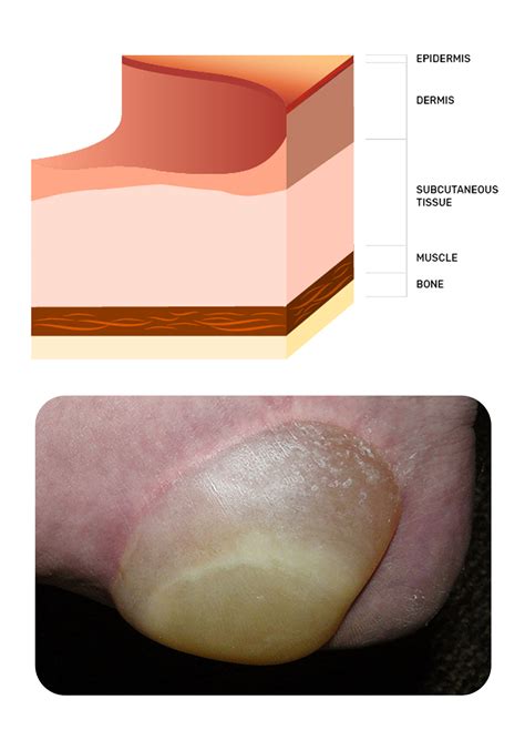 Pressure Ulcer Stage 1,2,3,4