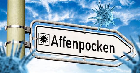 Drei Affenpocken F Lle In Deutschland