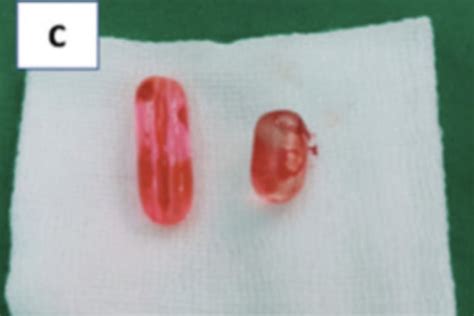 Schmerzhafter Sex Unfall Zahnb Rste Im Penis Bricht