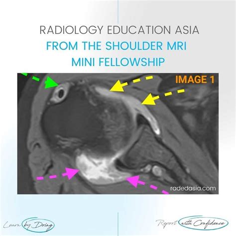 SHOULDER SYNOVITIS MRI RHEUMATOID ARTHRITIS - Radedasia