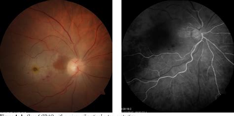 Figure 4 From Pars Plana Vitrectomy For Central Retinal Artery