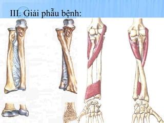 B5 gay pouteau û colle BỆNH NGOẠI KHOA PPT