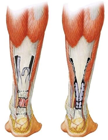 Разрывы ахиллова сухожилия — Травмаорто