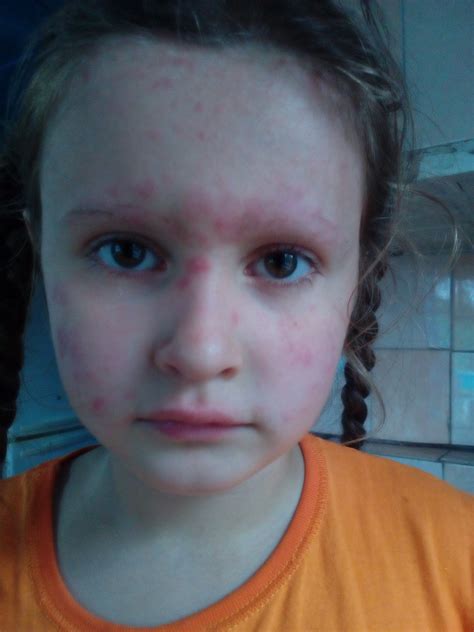 Сыпь на лице у ребенка - Вопрос аллергологу - 03 Онлайн