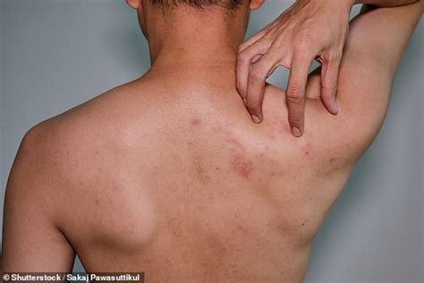 Millions Of Aussies Now Eligible For Free Shingles Vaccines Daily