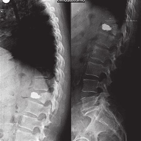 Lateral Thoracolumbar X Ray Showing A Vertebroplasty Of Th12