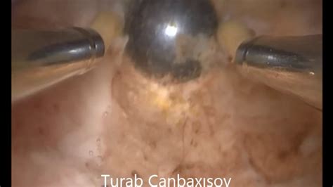 Hysteroscopic Endometrial Ablation Youtube