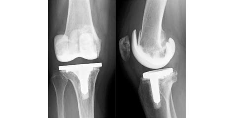 Radiological Imaging Of Aseptic Loosening Requiring Femoral And Tibial Download Scientific