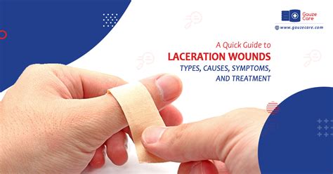 Quick Guide To Laceration Wounds Causes Types Treatment