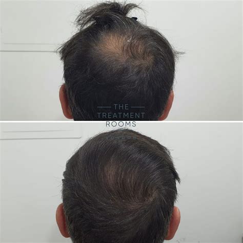 Balding Crown And Crown Hair Transplant Treatment Rooms London