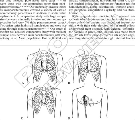 Miniparasternotomy Steps A Incision Right Para Sternal Skin