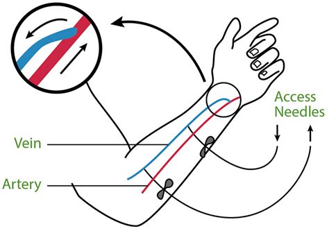 Dialysis Fistula Diagram