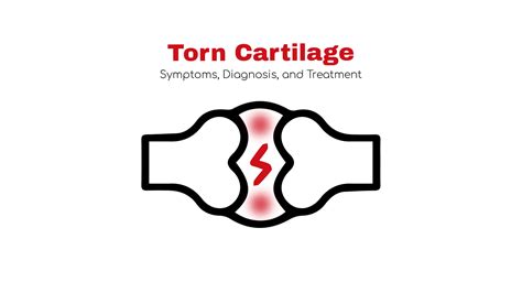 Torn Cartilagesymptomcauses Andtreatment Stat Cardiologist