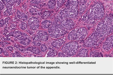 Figure From Incidental Detection And Management Of A Neuroendocrine