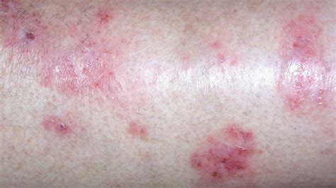 Types Of Eczema Identification Pictures And More