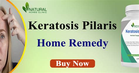 Natural Remedy For Keratosis Pilaris Archives Natural Herbs Clinic Blog