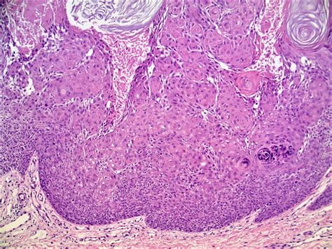 Pathology Outlines Inverted Follicular Keratosis | Sexiz Pix