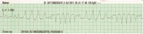 Pediatric Pulseless Ventricular Tachycardia Vt And Ventricular