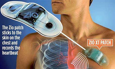 Zio adhesive patch can monitor heart beat for those who suffer from ...