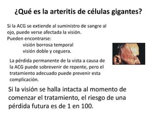 Arteritis De Celulas Gigantes Y Polimialgia Reumatica Doctor Farid