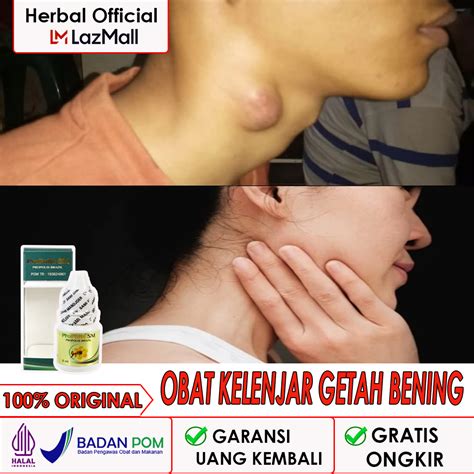 Propolis Original Asli Obat Kelenjar Getah Bening Obat Kelenjar Getah