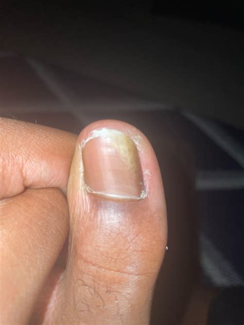 Does anyone know whats wrong with my toenail : r/Ingrown_Toenails
