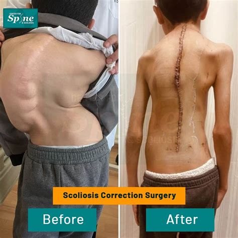 Spine Scoliosis Surgery In Delhi NCR India Scoliosis Surgeon Gurgaon