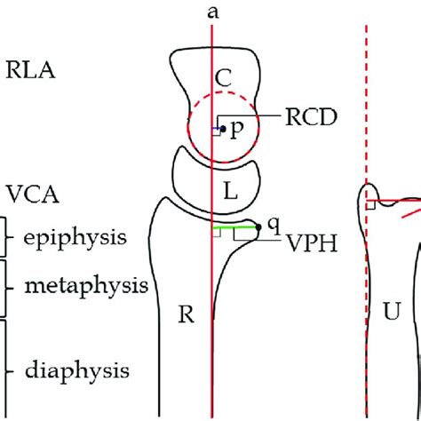 volar tilt vt  angle  lines    radiolunate angle