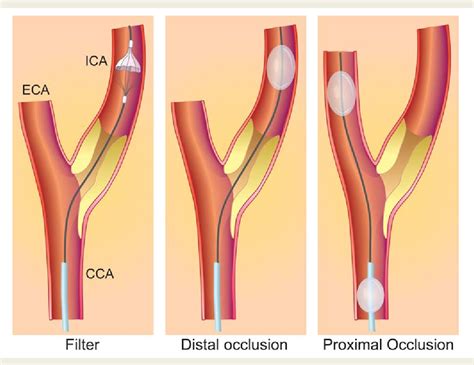 Carotid Angioplasty And Stenting Vs Carotid Endarterectomy For My Xxx Hot Girl