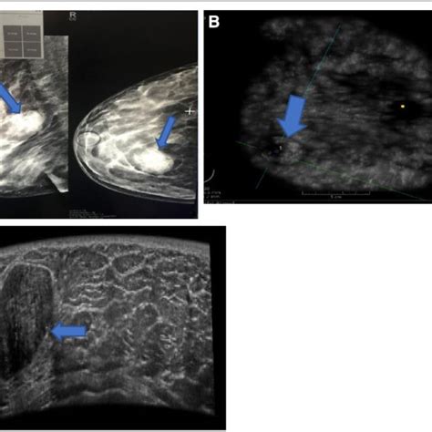 Comparison Between Detected Positive And Negative Lesions By Mammogram