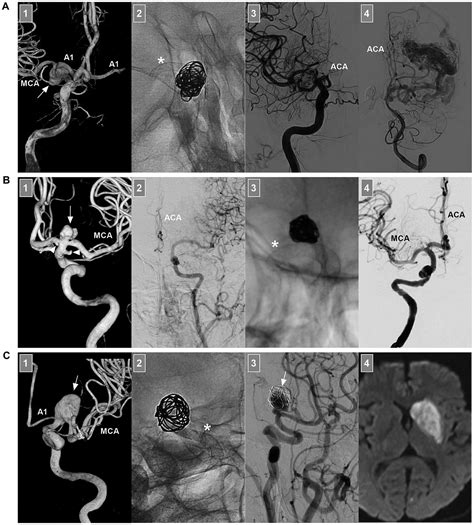 Frontiers Endovascular Treatment Of Intracranial Internal Carotid