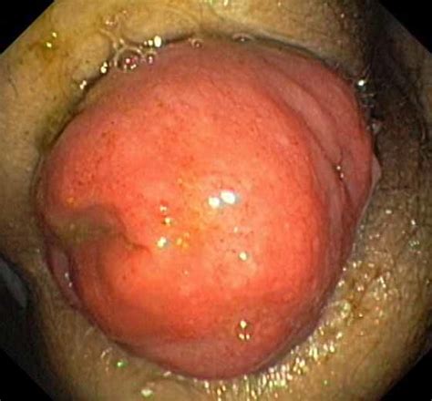 UTERINE PROLAPSE Porn Pictures XXX Photos Sex Images 4011040 PICTOA