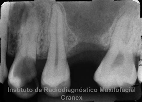 Cranex Caso Radiográfico N° 06 Sinusitis De Seno Maxilar En Relación A Comunicación Buco Sinusal