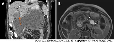 Drainage Of Pancreatic Fluid Collections In Acute Pancreatitis A