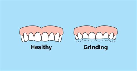 What Are Some Common Dental Procedures Royal Dental Clinics Blog