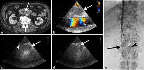 Intravascular Ultrasound-Guided Transvenous Biopsy of Retroperitoneal ...
